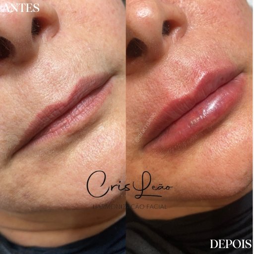 Preenchimento Labial (2)