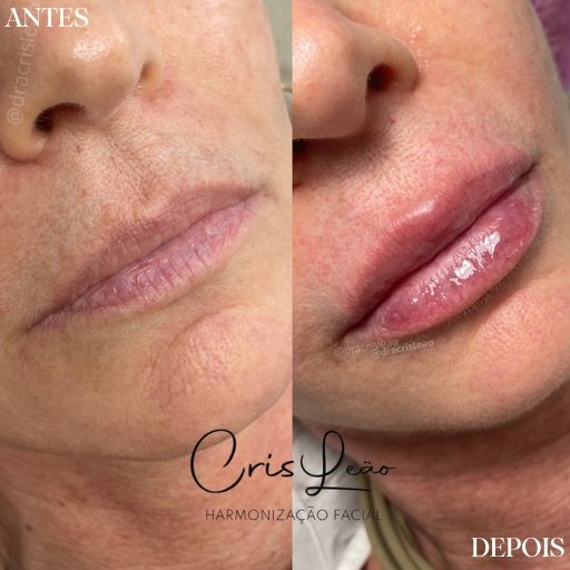 Preenchimento Labial (3)