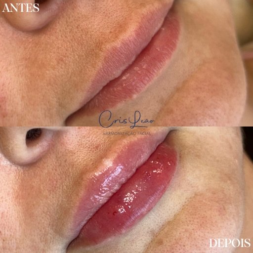 Preenchimento Labial (4)