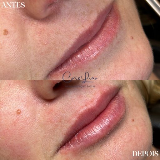 Preenchimento Labial (5)