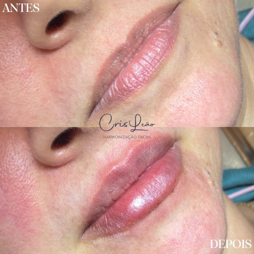Preenchimento Labial (6)