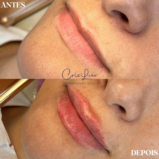 Preenchimento Labial (7)