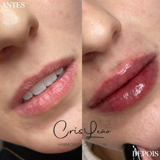 Preenchimento Labial
